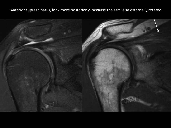 Figure 2 for case tendon of rotator cuff ( RID1948 )